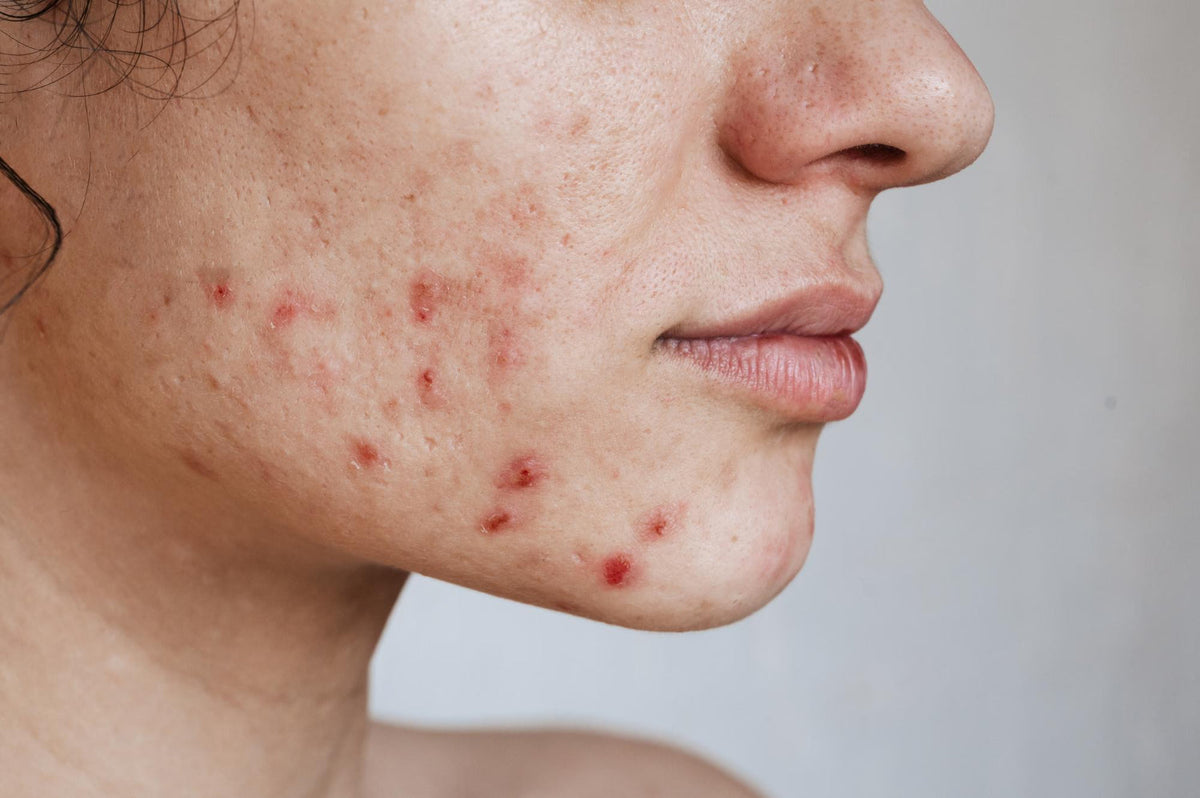 Closeup of the skin of a young girl with problems pimples acne pores scars
